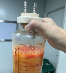 瓦房店水动力吸脂手术要做多久？